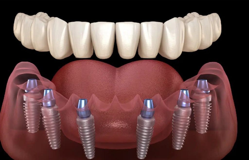 Full mouth rehabilitation at Best Smilles